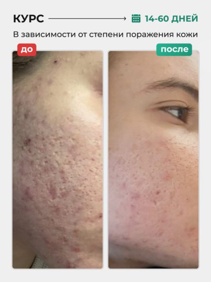 Сыворотка Ниацинамид Пептиды от прыщей и акне ACNE KILLER — изображение 2