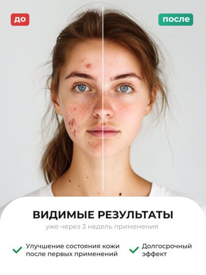 Сыворотка Ниацинамид Пептиды от прыщей и акне ACNE KILLER — изображение 14