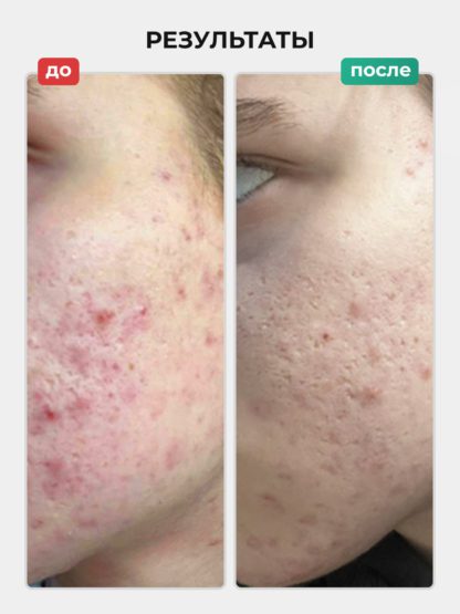 Сыворотка Ниацинамид Пептиды от прыщей и акне ACNE KILLER — изображение 17
